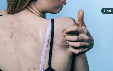 青春痘不只長臉上!醫揭「背痘」5大特徵:有臉痘者半數也長背痘