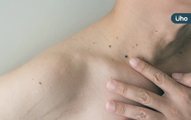 常曬太陽小心皮膚癌!林靜芸揪「基底細胞癌」4大特徵:別誤認痘疤