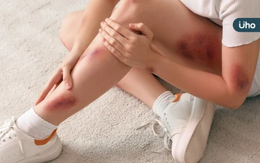 血友病患不再怕運動!健保給付「超長效藥物」:310人受惠年省近千萬