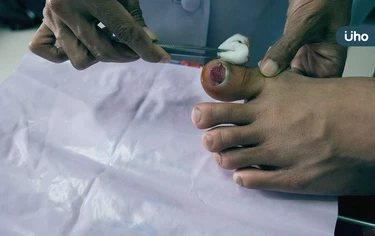 他小腿割傷「潰爛紅腫」險截肢!醫揭傷口清潔「先做這事」防感染