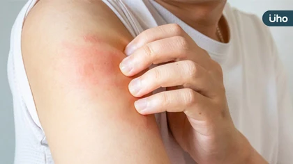 異膚治療不中斷!健保新藥想要「再上車」,病友該怎麼做?