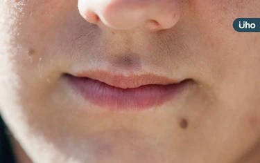 嘴唇黑點竟是癌變警訊?醫揪「黑斑息肉症候群」恐導致腸癌、乳癌