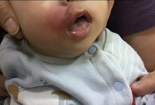 4月嬰遭蚊叮抓破皮 染蜂窩性組織炎