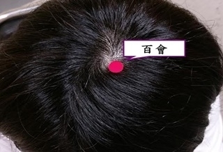 失眠加重掉髮 針灸治療一併改善