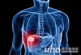 體力、食慾差 翁生10公分肝腫瘤