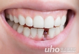 免補骨 1日手術還我漂亮牙