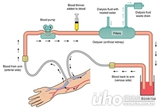 廔管感染　恐中斷腎友血路