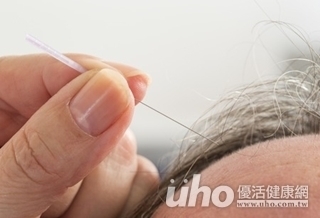 癌友氣血兩虛 針灸生髮展自信