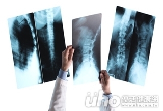 骨折險癱瘓 前側開刀可降風險