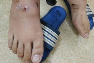 忽視傷口去戲水 腳腫如麵龜