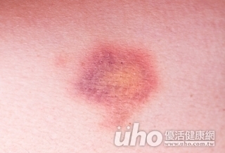 腋下莫名瘀青 恐為血友病!