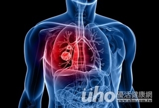 肺癌難開刀?微創手術可延壽