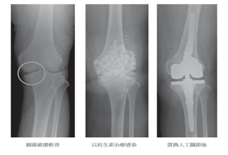 玻尿酸＝食鹽水？關節注射效果相同！