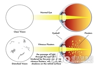 飛蚊變多　小心視網膜剝離！