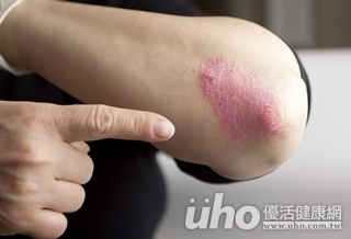 氣溫降 乾癬患者中風率高3倍