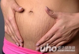 預防妊娠紋 3招有效搞定!