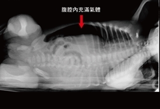 腹部氣脹　出生2天竟胃穿孔