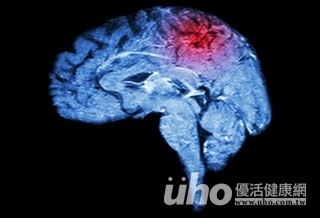 口齒不清 恐為腦中風前兆!