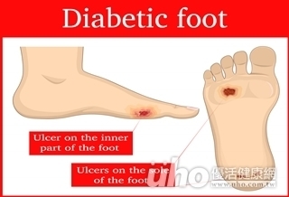 費用低免住院 足潰瘍這療法好有效