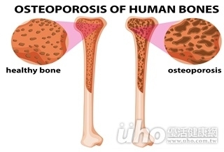骨鬆警報！這些族群要注意