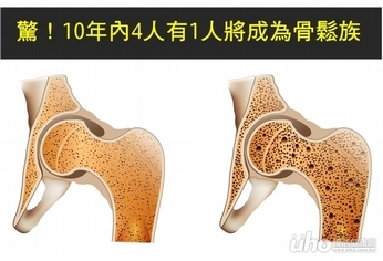 驚！10年內4人有1人將成為骨鬆族