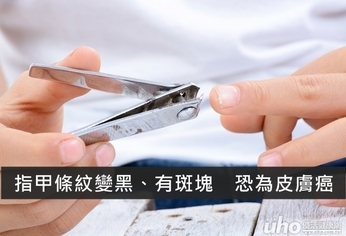 指甲條紋變黑、有斑塊 恐為皮膚癌