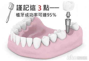 謹記3點　植牙成功率可達95％