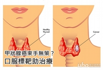 甲狀腺癌束手無策？口服標靶助治療