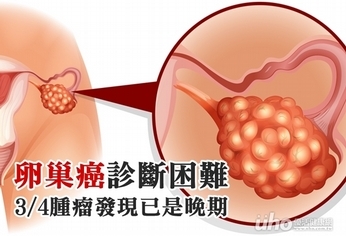 卵巢癌診斷困難　3/4腫瘤發現已是晚期