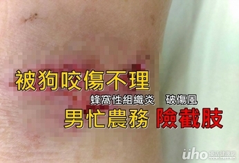被狗咬傷不理 男忙農務險截肢!