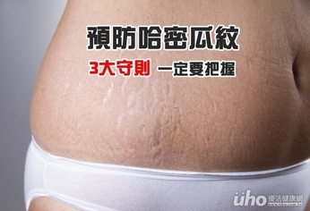 預防哈密瓜紋 3大守則一定要把握