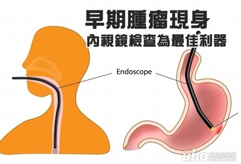 早期腫瘤現身　內視鏡檢查為最佳利器