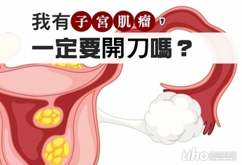 子宮肌瘤一定要開刀?妳有更好的選擇