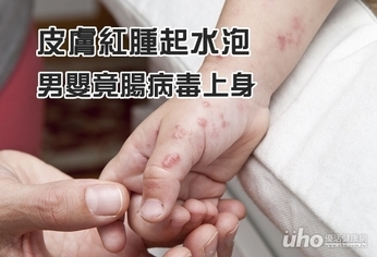 皮膚紅腫起水泡 男嬰竟腸病毒上身