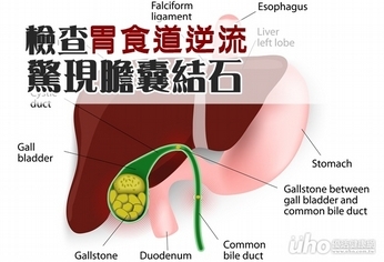 檢查胃食道逆流　驚現膽囊結石