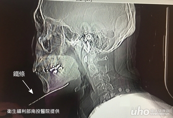 割草驚險記　鐵條差一吋險穿喉