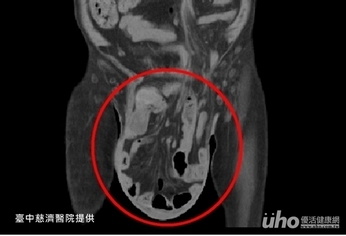 疝氣拖10年　陰囊腫成18公分大