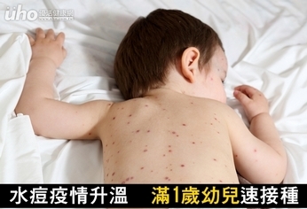 水痘疫情升溫！滿1歲幼兒速接種