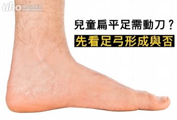 兒童扁平足需動刀?先看足弓形成與否