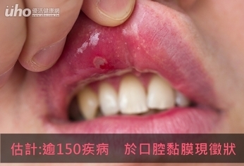 估計:逾150疾病　於口腔黏膜現徵狀