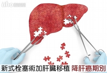 新式栓塞術加肝臟移植　降肝癌期別