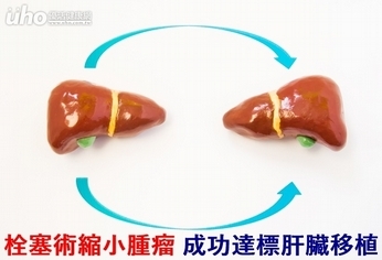 栓塞術縮小腫瘤　成功達標肝臟移植