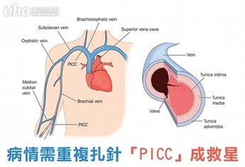 病情需重複扎針　「PICC」成救星