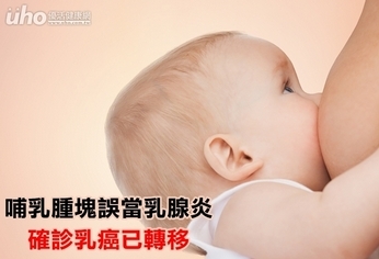 哺乳腫塊誤當乳腺炎 確診乳癌已轉移