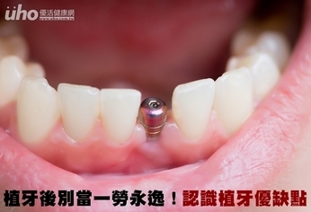 植牙後別當一勞永逸!認識植牙優缺點