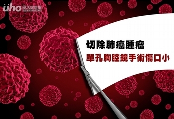 切除肺癌腫瘤　單孔胸腔鏡手術傷口小