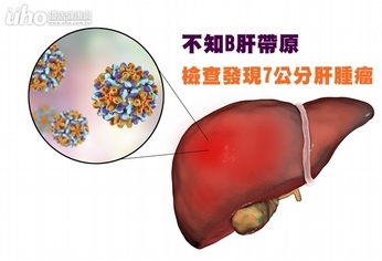 不知B肝帶原　檢查發現7公分肝腫瘤