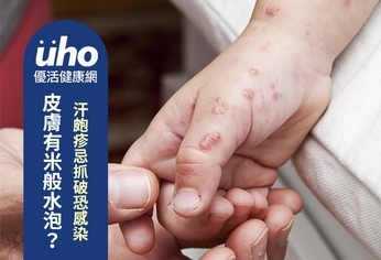 皮膚有米般水泡?汗皰疹忌抓破恐感染
