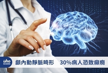 顱內動靜脈畸形　30%病人恐致癲癇