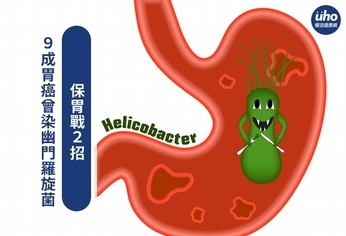 9成胃癌曾染幽門羅旋菌　保胃戰2招